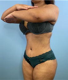 Tummy Tuck After Photo by Mark Markarian, MD, MSPH, FACS; Wellesley, MA - Case 47914