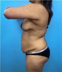 Tummy Tuck Before Photo by Mark Markarian, MD, MSPH, FACS; Wellesley, MA - Case 47914