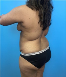 Tummy Tuck Before Photo by Mark Markarian, MD, MSPH, FACS; Wellesley, MA - Case 47914