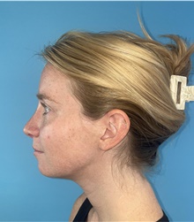 Rhinoplasty After Photo by Mark Markarian, MD, MSPH, FACS; Wellesley, MA - Case 47915