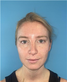 Rhinoplasty After Photo by Mark Markarian, MD, MSPH, FACS; Wellesley, MA - Case 47915