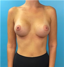 Breast Augmentation After Photo by Mark Markarian, MD, MSPH, FACS; Wellesley, MA - Case 47916