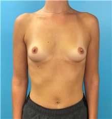 Breast Augmentation Before Photo by Mark Markarian, MD, MSPH, FACS; Wellesley, MA - Case 47916