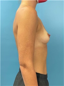 Breast Augmentation Before Photo by Mark Markarian, MD, MSPH, FACS; Wellesley, MA - Case 47916