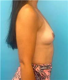 Breast Augmentation Before Photo by Mark Markarian, MD, MSPH, FACS; Wellesley, MA - Case 48012