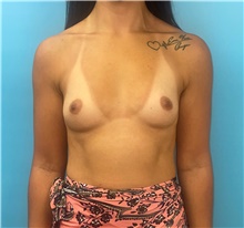 Breast Augmentation Before Photo by Mark Markarian, MD, MSPH, FACS; Wellesley, MA - Case 48012