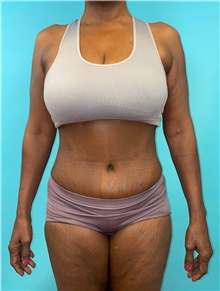 Tummy Tuck After Photo by Mark Markarian, MD, MSPH, FACS; Wellesley, MA - Case 48035