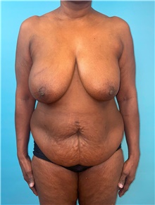 Tummy Tuck Before Photo by Mark Markarian, MD, MSPH, FACS; Wellesley, MA - Case 48035