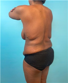 Tummy Tuck Before Photo by Mark Markarian, MD, MSPH, FACS; Wellesley, MA - Case 48035