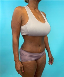 Tummy Tuck After Photo by Mark Markarian, MD, MSPH, FACS; Wellesley, MA - Case 48035