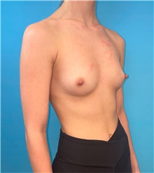 Breast Augmentation Before Photo by Mark Markarian, MD, MSPH, FACS; Wellesley, MA - Case 48275