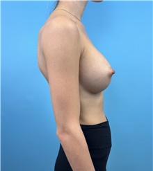 Breast Augmentation After Photo by Mark Markarian, MD, MSPH, FACS; Wellesley, MA - Case 48275