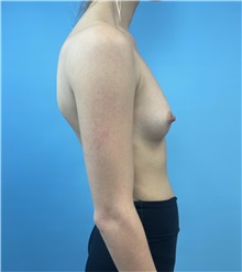 Breast Augmentation Before Photo by Mark Markarian, MD, MSPH, FACS; Wellesley, MA - Case 48275