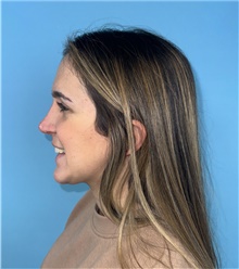 Rhinoplasty After Photo by Mark Markarian, MD, MSPH, FACS; Wellesley, MA - Case 48518