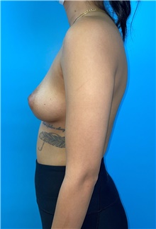 Breast Augmentation Before Photo by Mark Markarian, MD, MSPH, FACS; Wellesley, MA - Case 48520