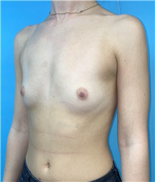 Breast Augmentation Before Photo by Mark Markarian, MD, MSPH, FACS; Wellesley, MA - Case 48521