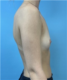 Breast Augmentation Before Photo by Mark Markarian, MD, MSPH, FACS; Wellesley, MA - Case 48521