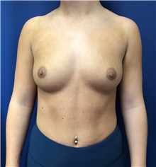 Breast Augmentation Before Photo by Mark Markarian, MD, MSPH, FACS; Wellesley, MA - Case 48522