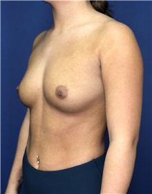 Breast Augmentation Before Photo by Mark Markarian, MD, MSPH, FACS; Wellesley, MA - Case 48522
