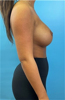 Breast Augmentation After Photo by Mark Markarian, MD, MSPH, FACS; Wellesley, MA - Case 48522