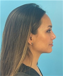 Rhinoplasty After Photo by Mark Markarian, MD, MSPH, FACS; Wellesley, MA - Case 48526