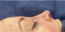 Rhinoplasty After Photo by Mark Markarian, MD, MSPH, FACS; Wellesley, MA - Case 48527