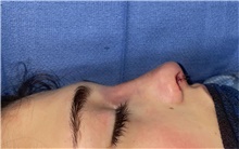 Rhinoplasty After Photo by Mark Markarian, MD, MSPH, FACS; Wellesley, MA - Case 48528