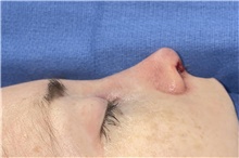 Rhinoplasty After Photo by Mark Markarian, MD, MSPH, FACS; Wellesley, MA - Case 48529