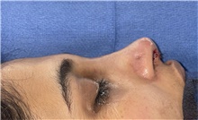 Rhinoplasty After Photo by Mark Markarian, MD, MSPH, FACS; Wellesley, MA - Case 48530
