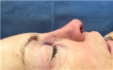 Rhinoplasty After Photo by Mark Markarian, MD, MSPH, FACS; Wellesley, MA - Case 48531