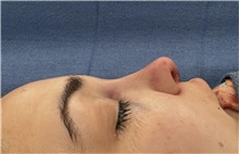 Rhinoplasty After Photo by Mark Markarian, MD, MSPH, FACS; Wellesley, MA - Case 48532