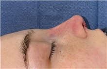 Rhinoplasty After Photo by Mark Markarian, MD, MSPH, FACS; Wellesley, MA - Case 48533