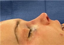 Rhinoplasty After Photo by Mark Markarian, MD, MSPH, FACS; Wellesley, MA - Case 48534