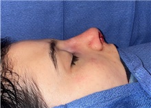 Rhinoplasty After Photo by Mark Markarian, MD, MSPH, FACS; Wellesley, MA - Case 48535