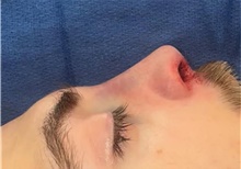 Rhinoplasty After Photo by Mark Markarian, MD, MSPH, FACS; Wellesley, MA - Case 48536