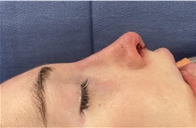 Rhinoplasty After Photo by Mark Markarian, MD, MSPH, FACS; Wellesley, MA - Case 48540
