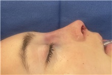 Rhinoplasty After Photo by Mark Markarian, MD, MSPH, FACS; Wellesley, MA - Case 48541