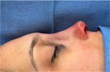 Rhinoplasty After Photo by Mark Markarian, MD, MSPH, FACS; Wellesley, MA - Case 48542