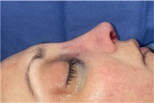 Rhinoplasty After Photo by Mark Markarian, MD, MSPH, FACS; Wellesley, MA - Case 48543
