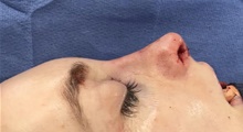 Rhinoplasty After Photo by Mark Markarian, MD, MSPH, FACS; Wellesley, MA - Case 48545
