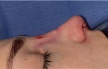 Rhinoplasty After Photo by Mark Markarian, MD, MSPH, FACS; Wellesley, MA - Case 48546