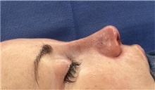 Rhinoplasty After Photo by Mark Markarian, MD, MSPH, FACS; Wellesley, MA - Case 48547