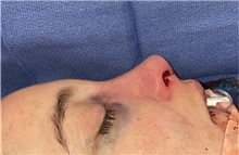 Rhinoplasty After Photo by Mark Markarian, MD, MSPH, FACS; Wellesley, MA - Case 48549