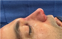 Rhinoplasty After Photo by Mark Markarian, MD, MSPH, FACS; Wellesley, MA - Case 48550
