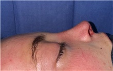 Rhinoplasty After Photo by Mark Markarian, MD, MSPH, FACS; Wellesley, MA - Case 48551