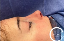 Rhinoplasty After Photo by Mark Markarian, MD, MSPH, FACS; Wellesley, MA - Case 48552
