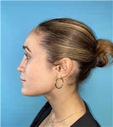Rhinoplasty After Photo by Mark Markarian, MD, MSPH, FACS; Wellesley, MA - Case 48554