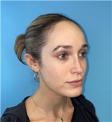 Rhinoplasty After Photo by Mark Markarian, MD, MSPH, FACS; Wellesley, MA - Case 48554