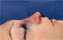 Rhinoplasty After Photo by Mark Markarian, MD, MSPH, FACS; Wellesley, MA - Case 48555