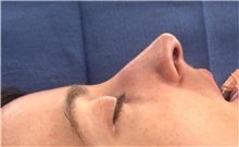 Rhinoplasty After Photo by Mark Markarian, MD, MSPH, FACS; Wellesley, MA - Case 48586